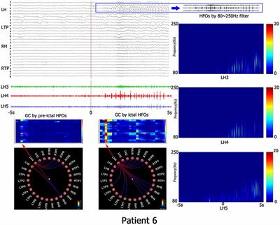 Ictal High-Frequency Oscillation for Lateralizing Patients With Suspected Bitemporal Epilepsy Using Wavelet Transform and Granger Causality Analysis